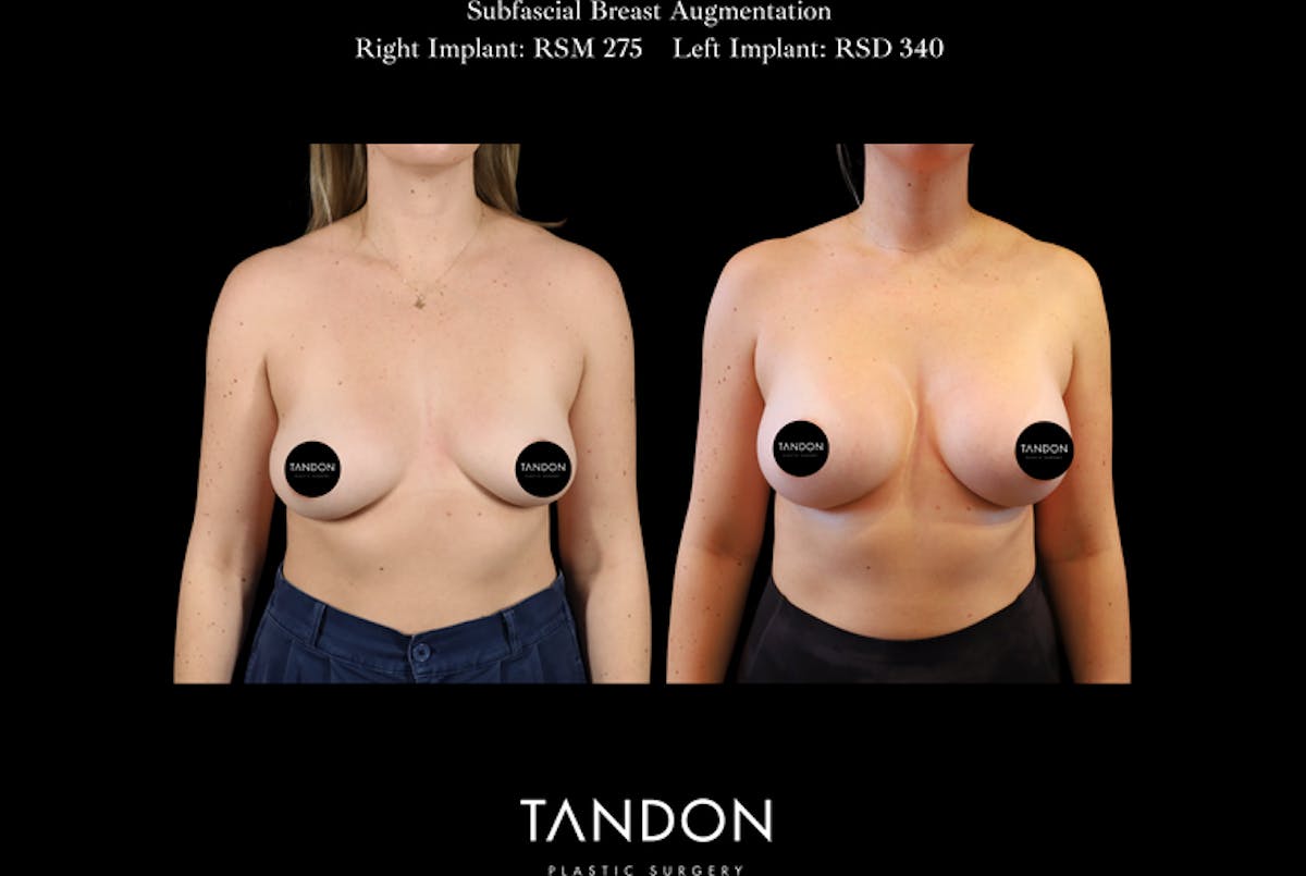 Breast Augmentation Before & After Gallery - Patient 288114 - Image 1