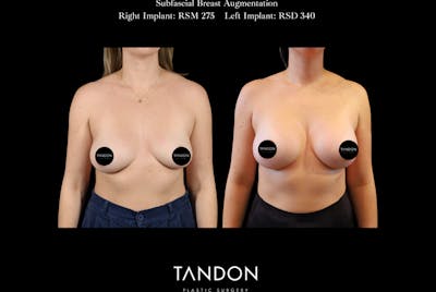Breast Augmentation Before & After Gallery - Patient 288114 - Image 1