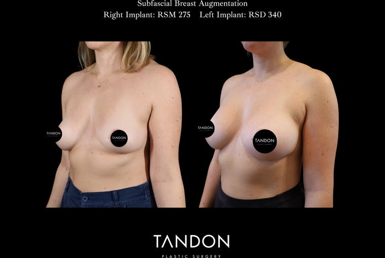 Breast Augmentation Before & After Gallery - Patient 288114 - Image 4