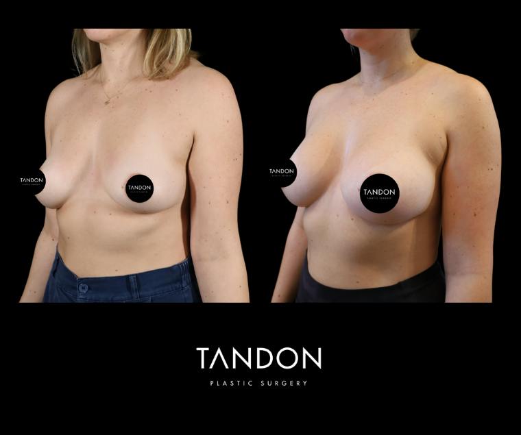 Breast Augmentation Before & After Gallery - Patient 288114 - Image 4