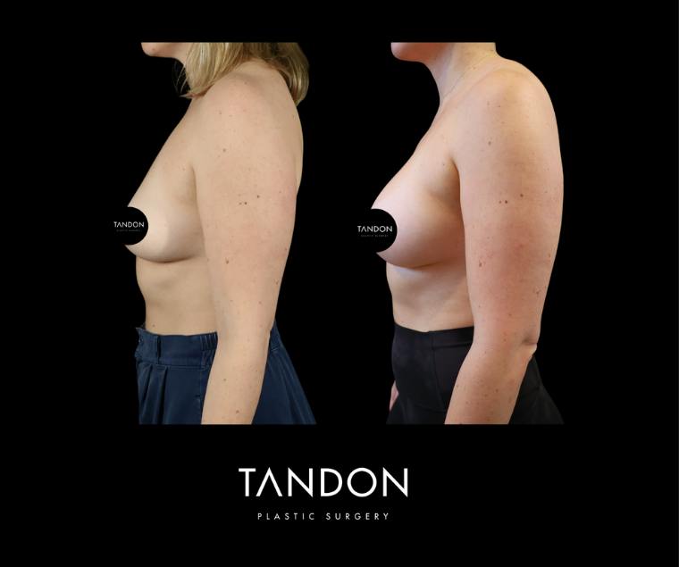 Breast Augmentation Before & After Gallery - Patient 288114 - Image 5