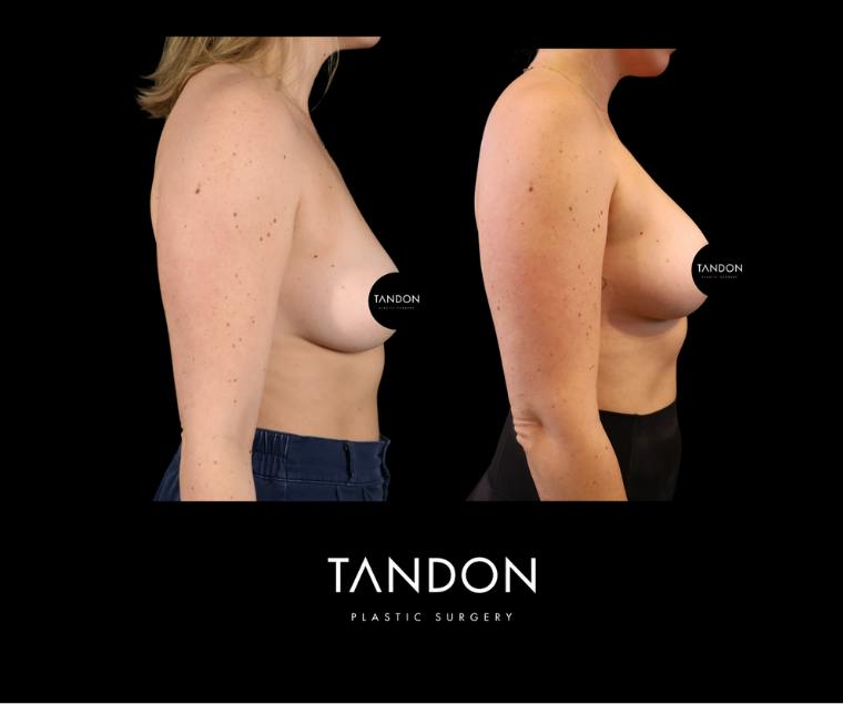 Breast Augmentation Before & After Gallery - Patient 288114 - Image 3