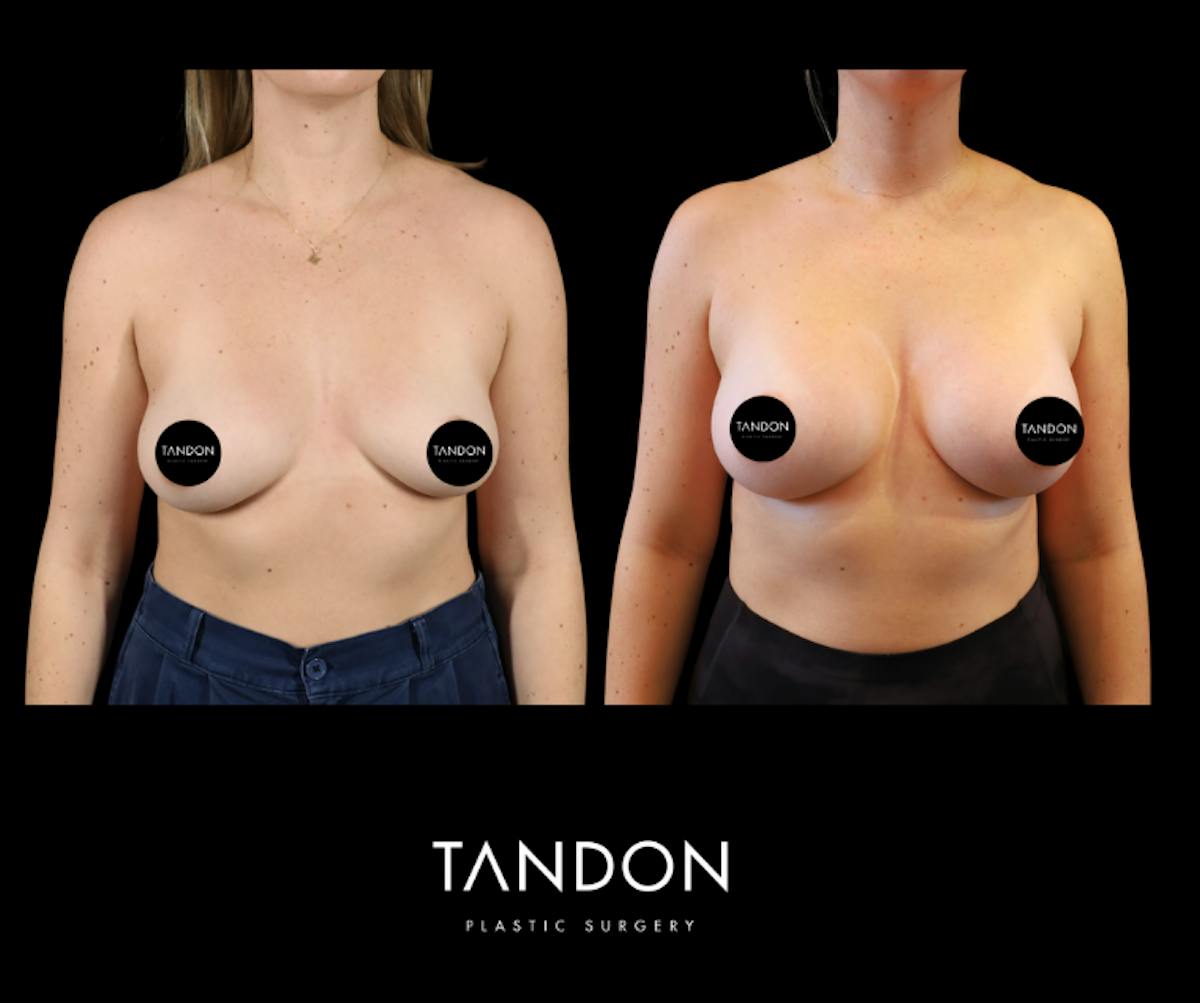 Breast Augmentation  Before & After Gallery - Patient 288114 - Image 1