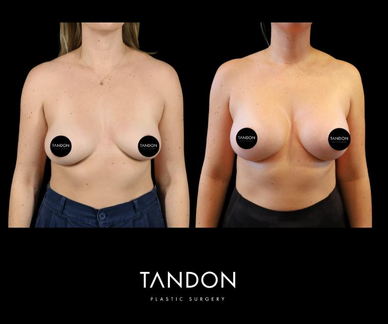 Breast Augmentation Before & After Gallery - Patient 288114 - Image 1