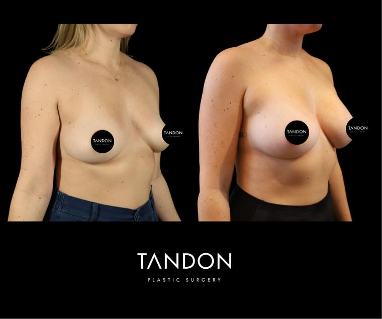 Breast Augmentation Before & After Gallery - Patient 288114 - Image 2