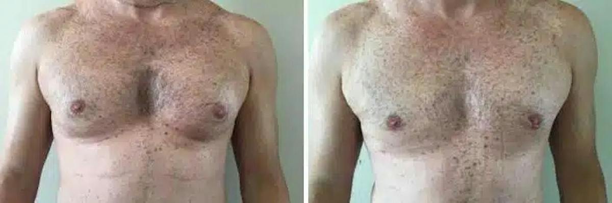 Male Breast Reduction (Gynecomastia) Before & After Gallery - Patient 119802 - Image 1