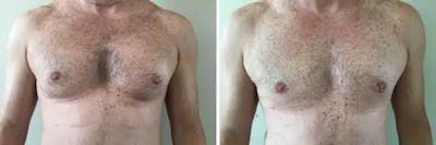 Male Breast Reduction (Gynecomastia) Before & After Gallery - Patient 119802 - Image 1