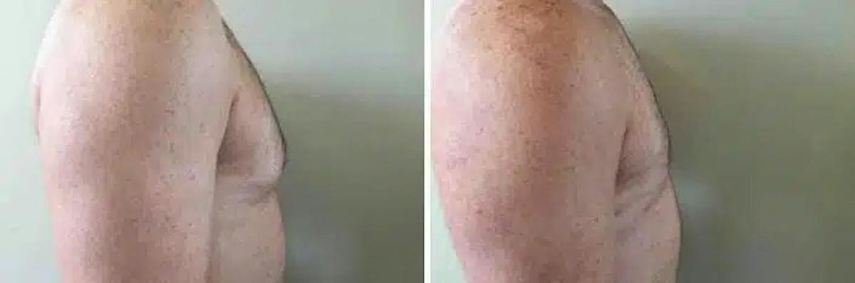 Male Breast Reduction (Gynecomastia) Before & After Gallery - Patient 119802 - Image 3