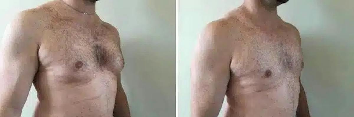 Male Breast Reduction (Gynecomastia) Before & After Gallery - Patient 119802 - Image 2