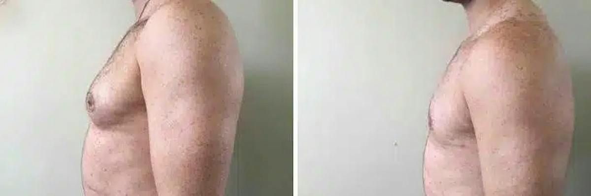 Male Breast Reduction (Gynecomastia) Before & After Gallery - Patient 119802 - Image 4
