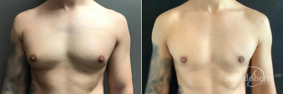 Male Breast Reduction (Gynecomastia) Before & After Gallery - Patient 224787 - Image 1