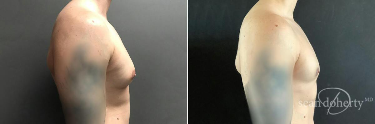 Male Breast Reduction (Gynecomastia) Before & After Gallery - Patient 224787 - Image 3