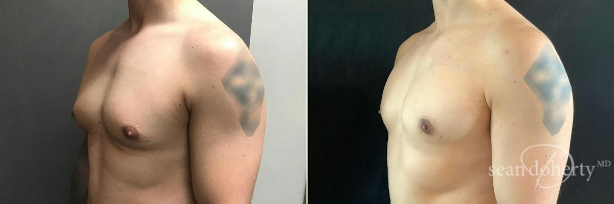 Male Breast Reduction (Gynecomastia) Before & After Gallery - Patient 224787 - Image 2