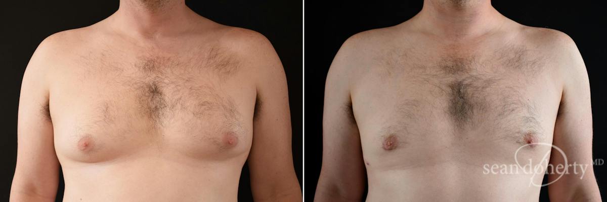 Male Breast Reduction (Gynecomastia) Before & After Gallery - Patient 158887 - Image 1