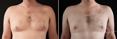 Male Breast Reduction (Gynecomastia) Before & After Gallery - Patient 158887 - Image 1