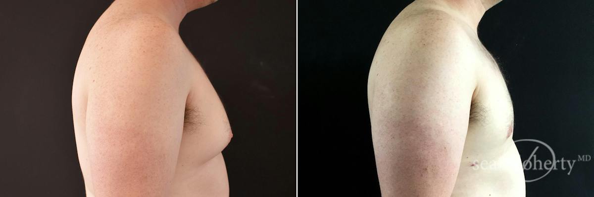 Male Breast Reduction (Gynecomastia) Before & After Gallery - Patient 158887 - Image 3