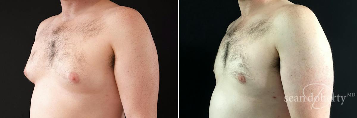 Male Breast Reduction (Gynecomastia) Before & After Gallery - Patient 158887 - Image 2