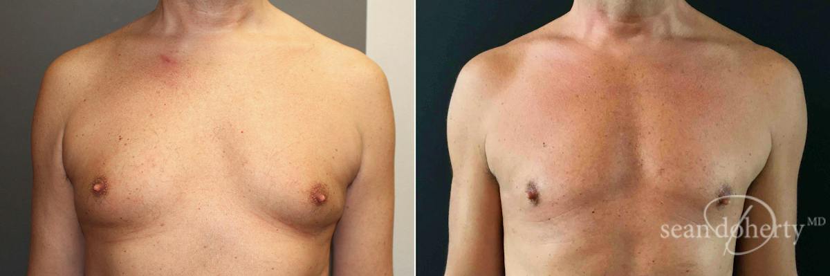 Male Breast Reduction (Gynecomastia) Before & After Gallery - Patient 427443 - Image 1