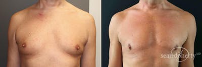 Male Breast Reduction (Gynecomastia) Before & After Gallery - Patient 427443 - Image 1