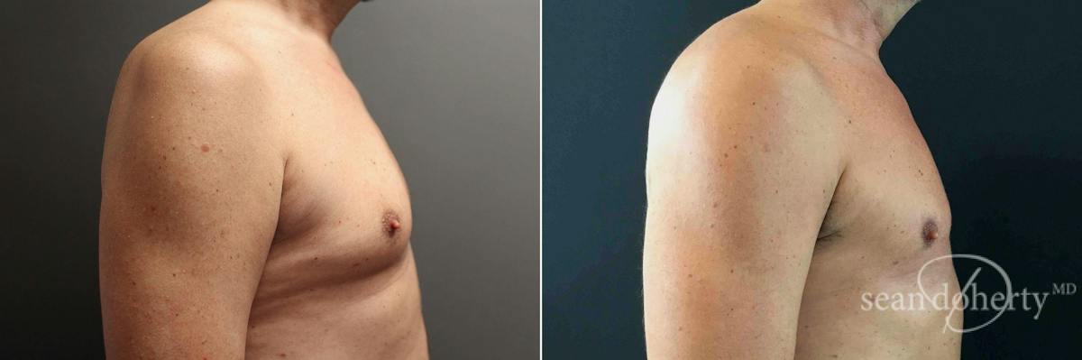 Male Breast Reduction (Gynecomastia) Before & After Gallery - Patient 427443 - Image 3