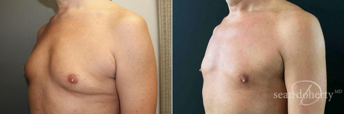 Male Breast Reduction (Gynecomastia) Before & After Gallery - Patient 427443 - Image 2