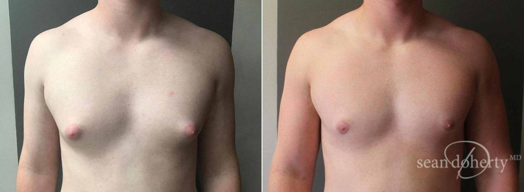 Male Breast Reduction (Gynecomastia) Before & After Gallery - Patient 333784 - Image 1