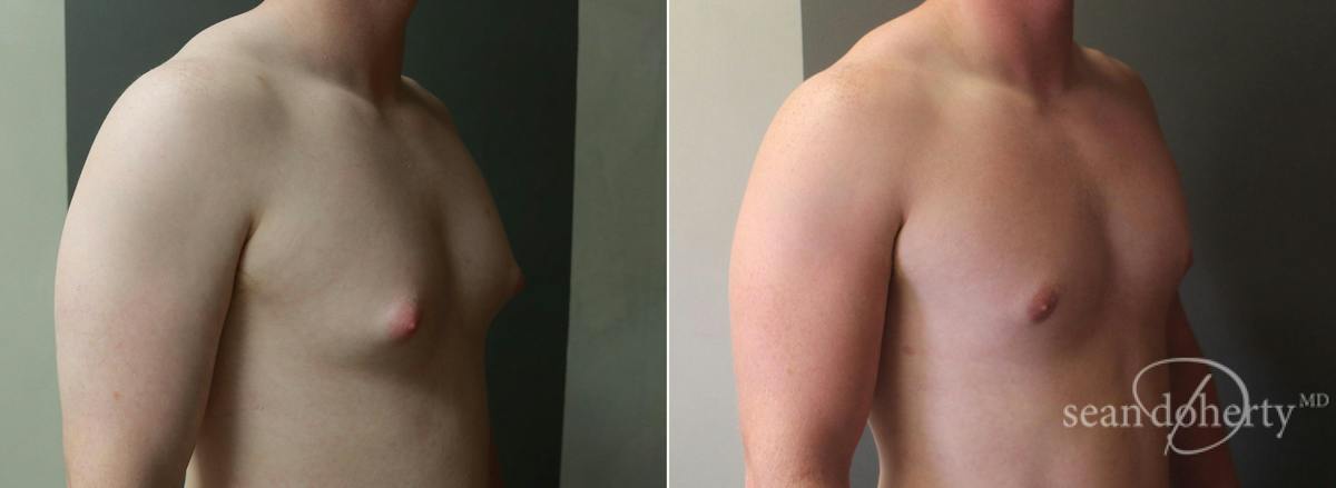 Male Breast Reduction (Gynecomastia) Before & After Gallery - Patient 333784 - Image 2