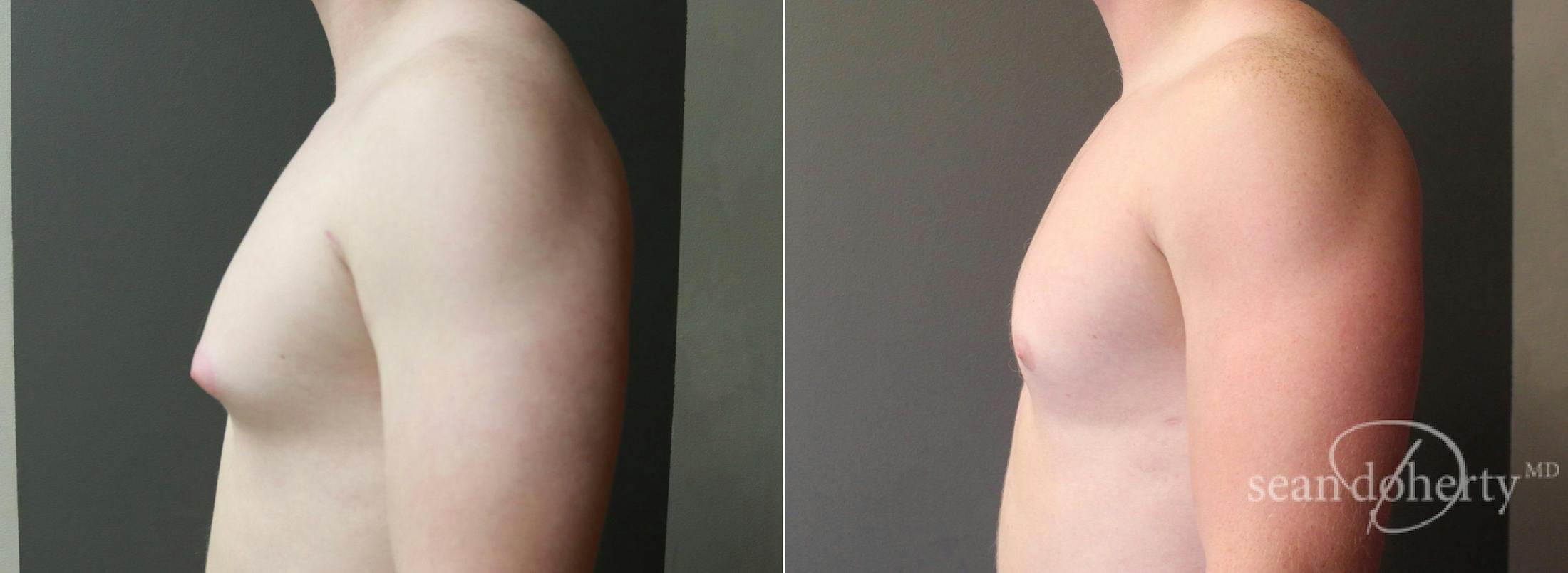 Male Breast Reduction (Gynecomastia) Before & After Gallery - Patient 333784 - Image 3