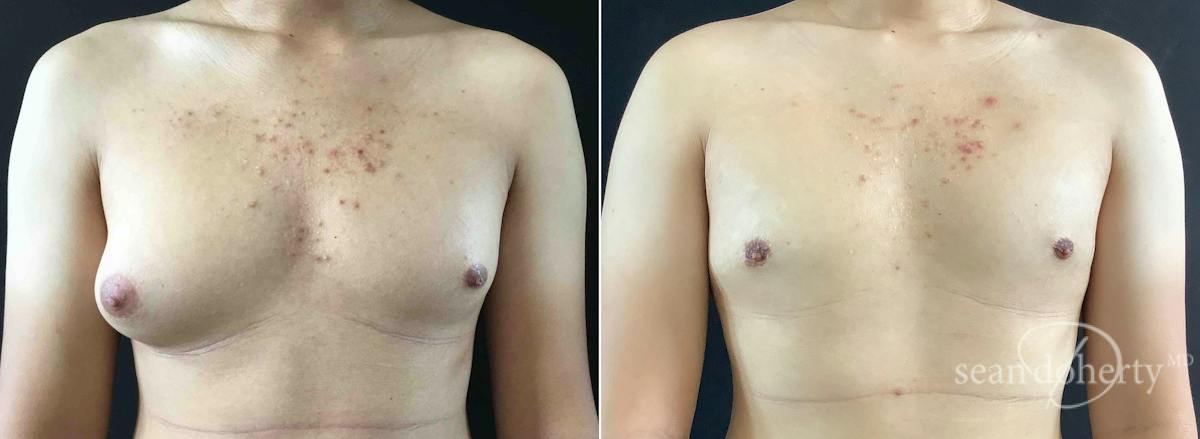 Male Breast Reduction (Gynecomastia) Before & After Gallery - Patient 118915 - Image 1