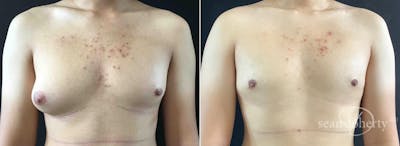 Male Breast Reduction (Gynecomastia) Before & After Gallery - Patient 118915 - Image 1