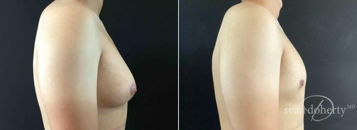 Male Breast Reduction (Gynecomastia) Before & After Gallery - Patient 118915 - Image 3