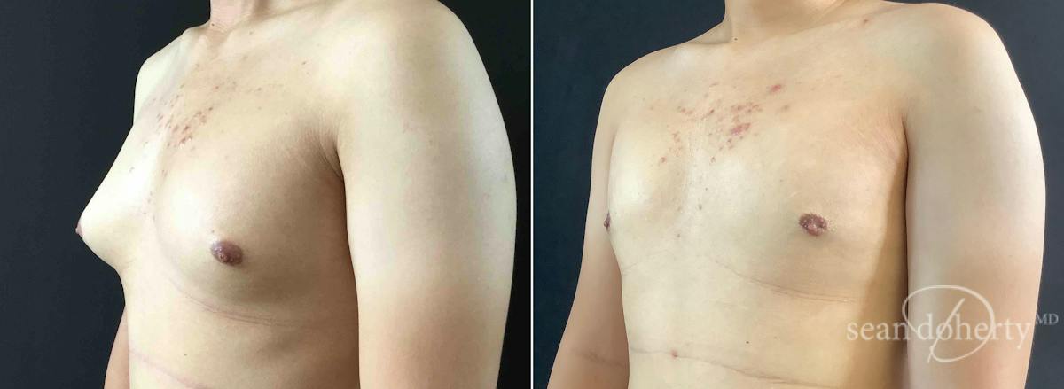 Male Breast Reduction (Gynecomastia) Before & After Gallery - Patient 118915 - Image 2