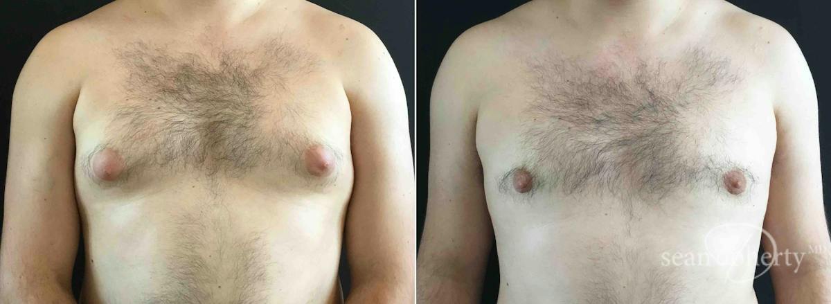 Male Breast Reduction (Gynecomastia) Before & After Gallery - Patient 183421 - Image 1
