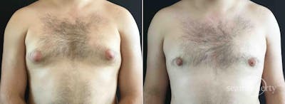 Male Breast Reduction (Gynecomastia) Before & After Gallery - Patient 183421 - Image 1