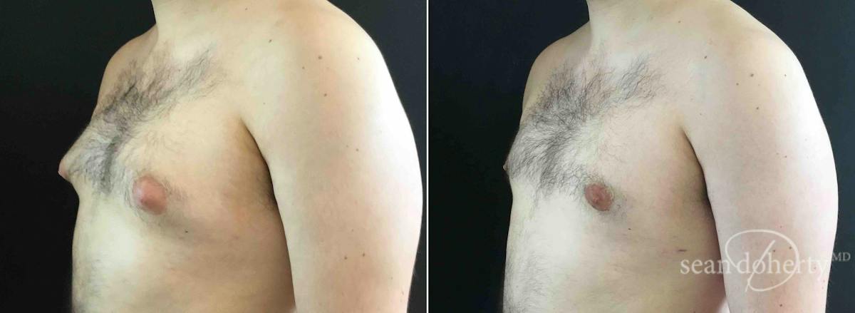 Male Breast Reduction (Gynecomastia) Before & After Gallery - Patient 183421 - Image 2