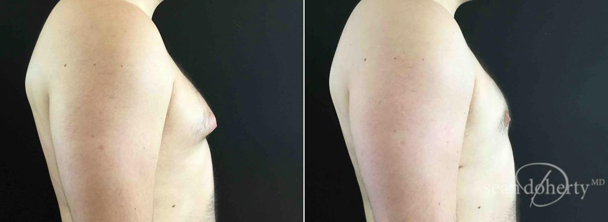 Male Breast Reduction (Gynecomastia) Before & After Gallery - Patient 183421 - Image 3