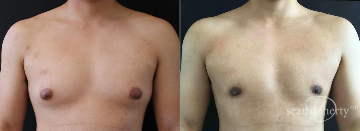 Male Breast Reduction (Gynecomastia) Before & After Gallery - Patient 766677 - Image 1