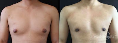 Male Breast Reduction (Gynecomastia) Before & After Gallery - Patient 766677 - Image 1