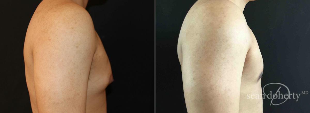 Male Breast Reduction (Gynecomastia) Before & After Gallery - Patient 766677 - Image 3