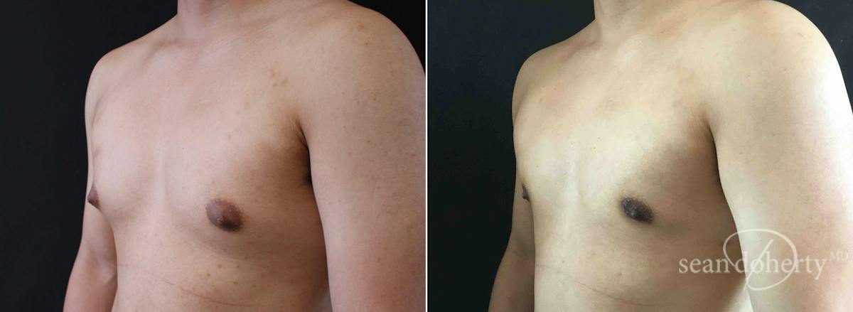Male Breast Reduction (Gynecomastia) Before & After Gallery - Patient 766677 - Image 2