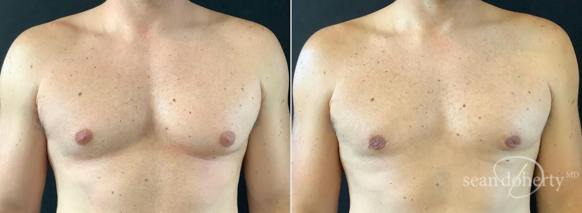 Male Breast Reduction (Gynecomastia) Before & After Gallery - Patient 147866 - Image 1