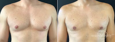 Male Breast Reduction (Gynecomastia) Before & After Gallery - Patient 147866 - Image 1