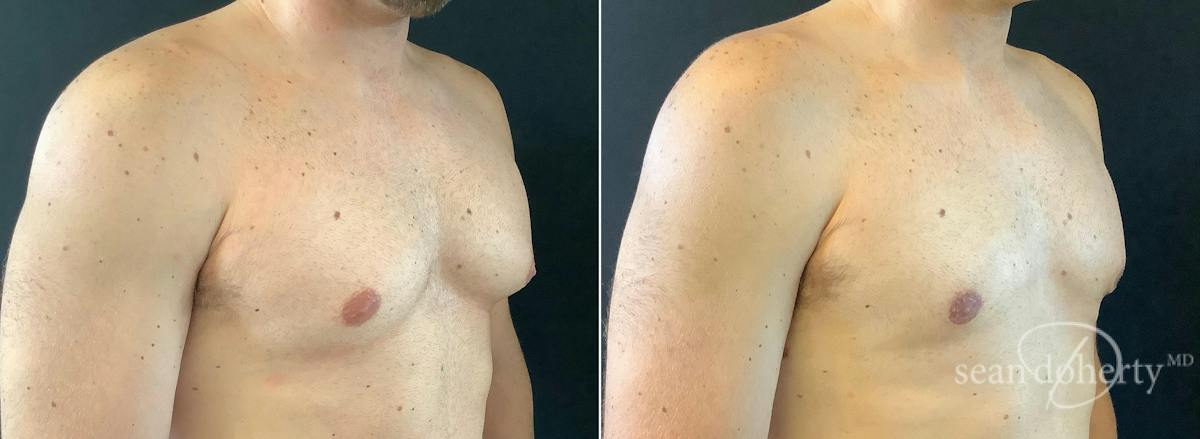 Male Breast Reduction (Gynecomastia) Before & After Gallery - Patient 147866 - Image 2