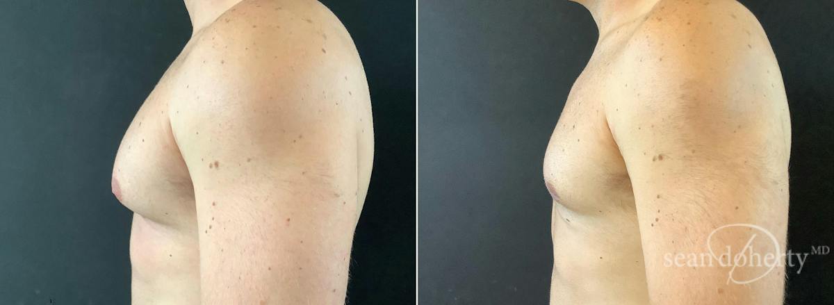 Male Breast Reduction (Gynecomastia) Before & After Gallery - Patient 147866 - Image 3