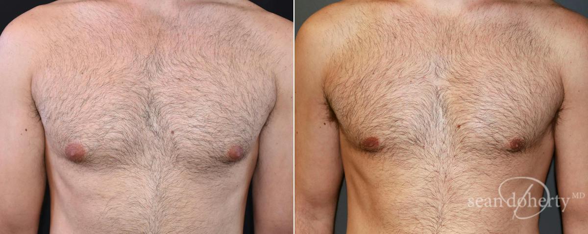 Male Breast Reduction (Gynecomastia) Before & After Gallery - Patient 414386 - Image 1