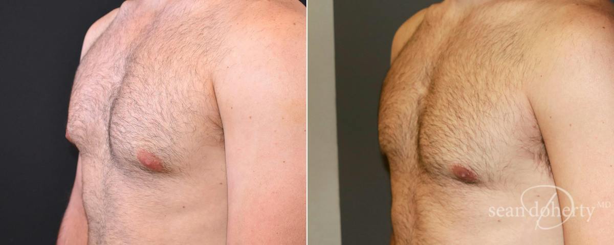 Male Breast Reduction (Gynecomastia) Before & After Gallery - Patient 414386 - Image 2