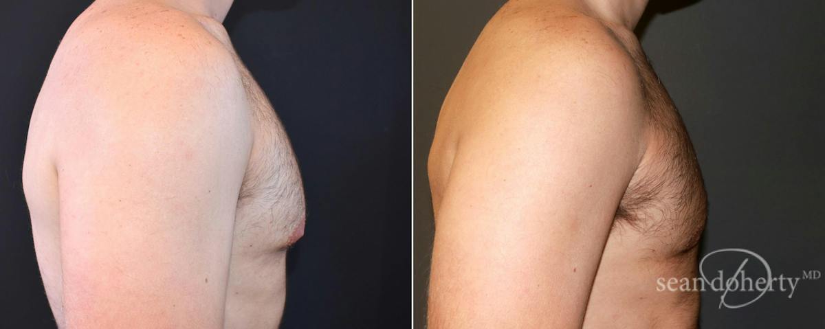 Male Breast Reduction (Gynecomastia) Before & After Gallery - Patient 414386 - Image 3