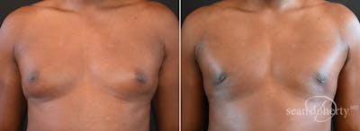 Male Breast Reduction (Gynecomastia) Before & After Gallery - Patient 372587 - Image 1