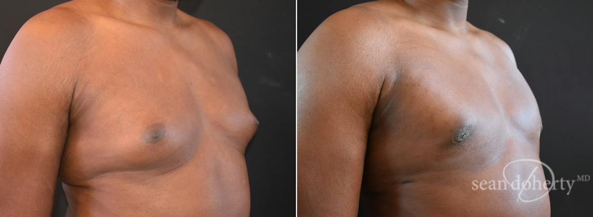 Male Breast Reduction (Gynecomastia) Before & After Gallery - Patient 372587 - Image 2