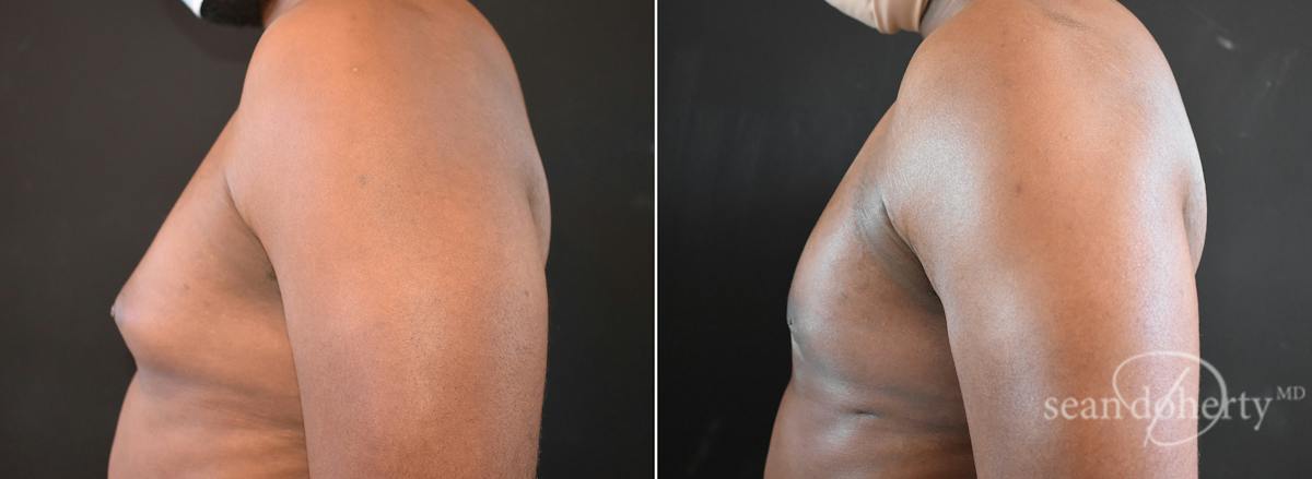 Male Breast Reduction (Gynecomastia) Before & After Gallery - Patient 372587 - Image 3